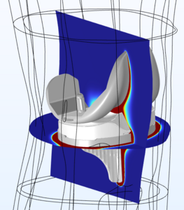 Simulation of Medical Treatment for Infections After Knee Replacement ...