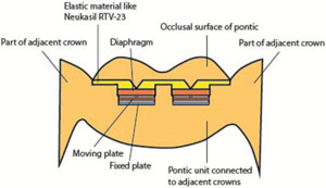 Design of a Pressure Sensor to Monitor Teeth Grinding